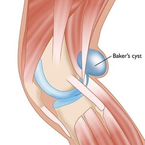 Baker's Cyst Aspirate