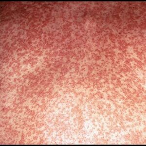 Rubella Naokon