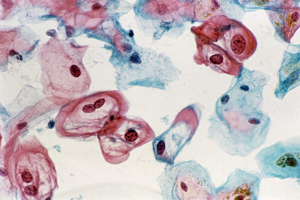 Cervical Smear