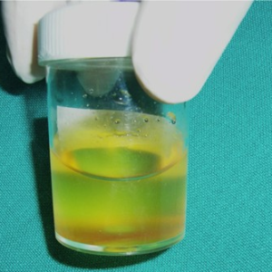 Cystic Fluid Analysis