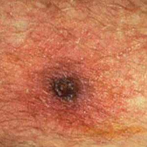 Scrub Typhus Antibody Test Naokon