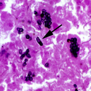 Naokon Sputum P.marneffei